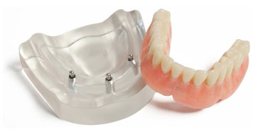 Prothèse dentaire sur implant